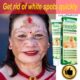 Get Rid Of Vitiligo, Scars And Stretch Marks In Gatineau City in Canada Call +27710732372